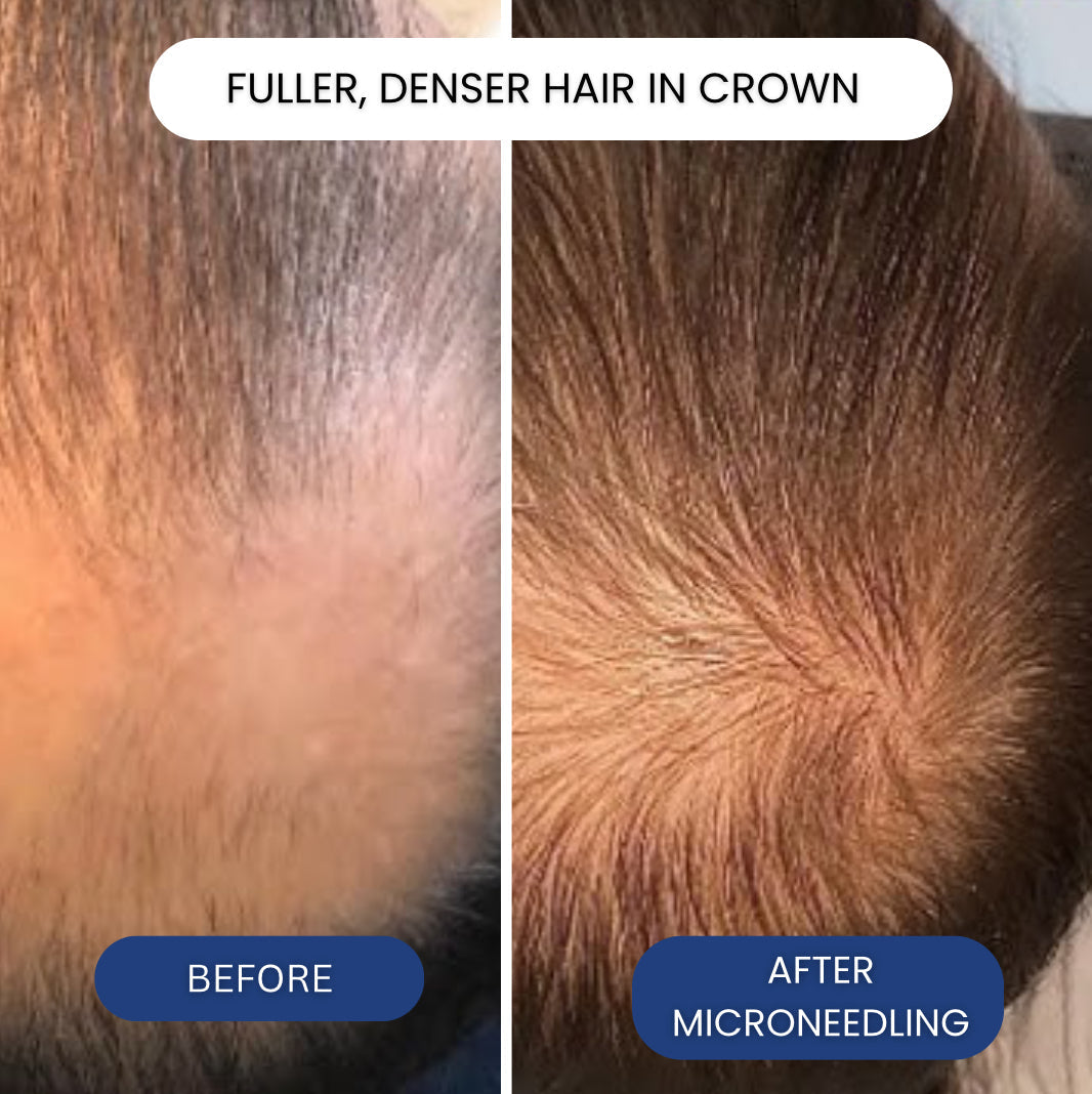 The Most Powerful Peptide Infusion  Hair Regrowth System